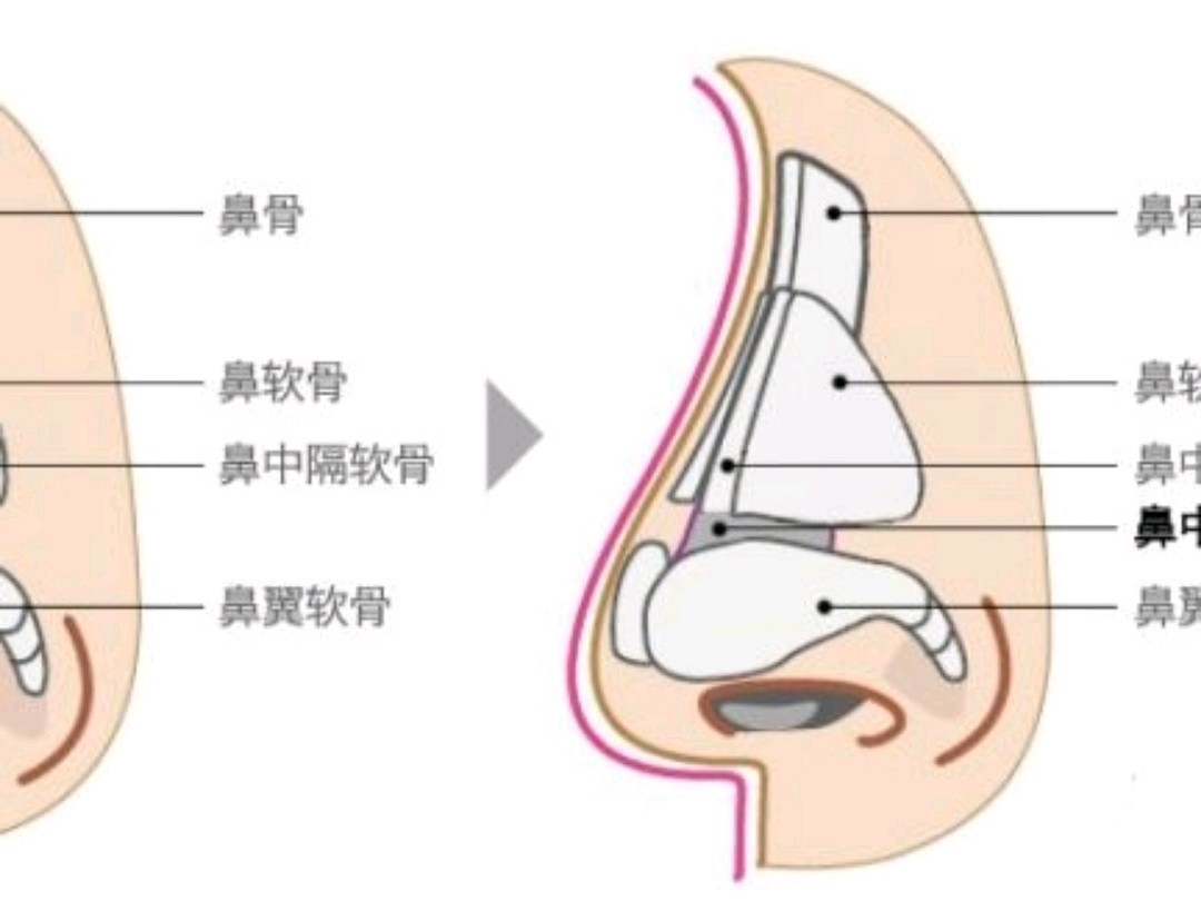 拯救你的"朝天鼻",鼻中隔延长请了解一下