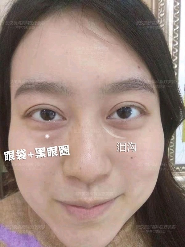 前段时间有个有眼袋问题的宝宝到医院咨询,她不仅眼袋很明显,而且