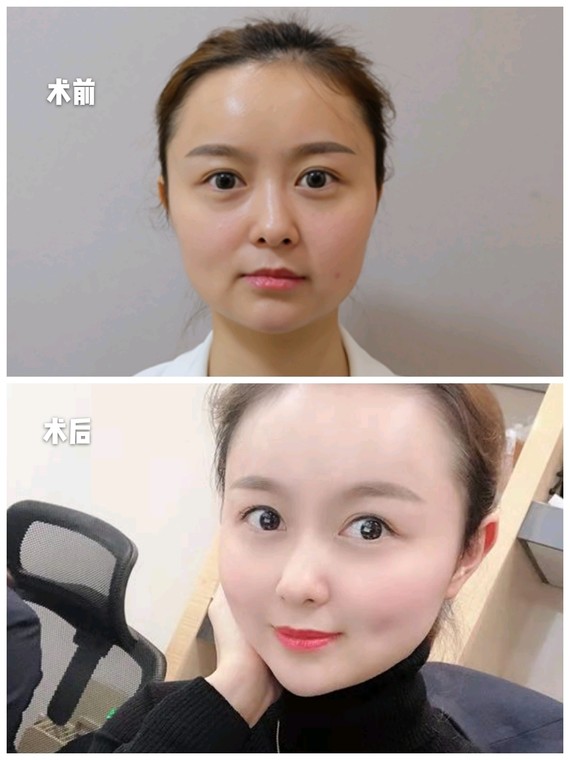 面部提升