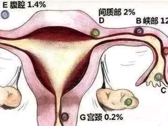 其中百分之90-95%发生在输卵管,称输卵管妊娠,且又以壶腹部最多(75%