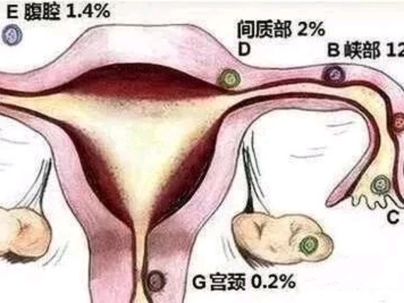 受精卵在子宫体腔以外着床称为异位妊娠,俗称宫外孕.