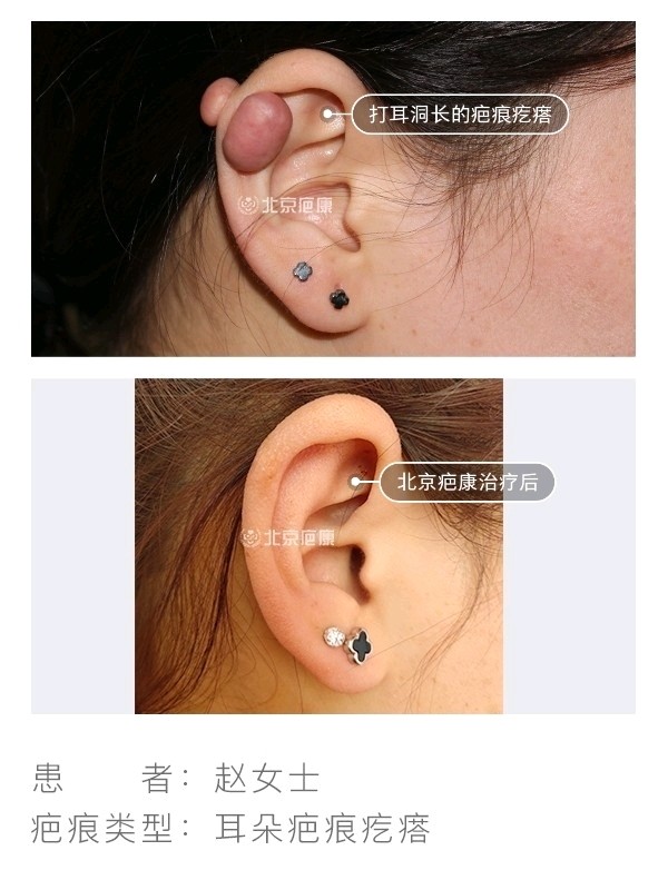 来自河北的赵女士,因打耳洞导致耳廓凸起疤痕疙瘩2年