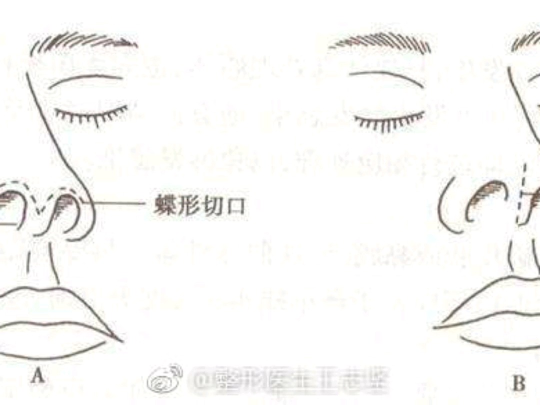 科普:隆鼻切口分为外切和内切,有什么区别呢?