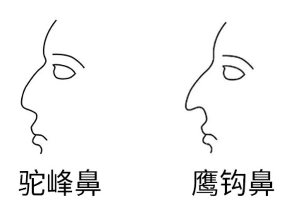 隆起有如骆驼之峰者称为驼峰鼻,若加上鼻尖钩下如鹰之嘴时,则为鹰钩鼻