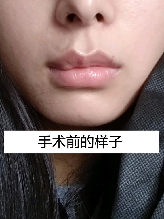提问帖#这个凹陷不正常吧?