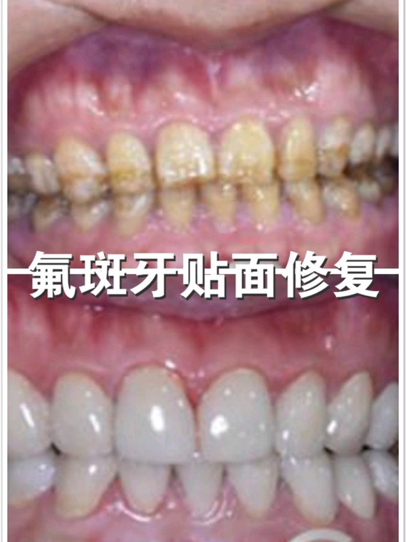 氟斑牙又称斑釉或黄斑牙,是一种与饮用水中氟