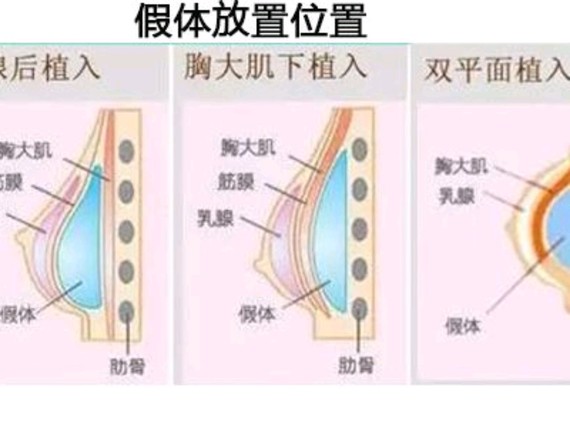 首先假体隆胸手术切口一般在腋窝,乳晕或者乳房下皱处.