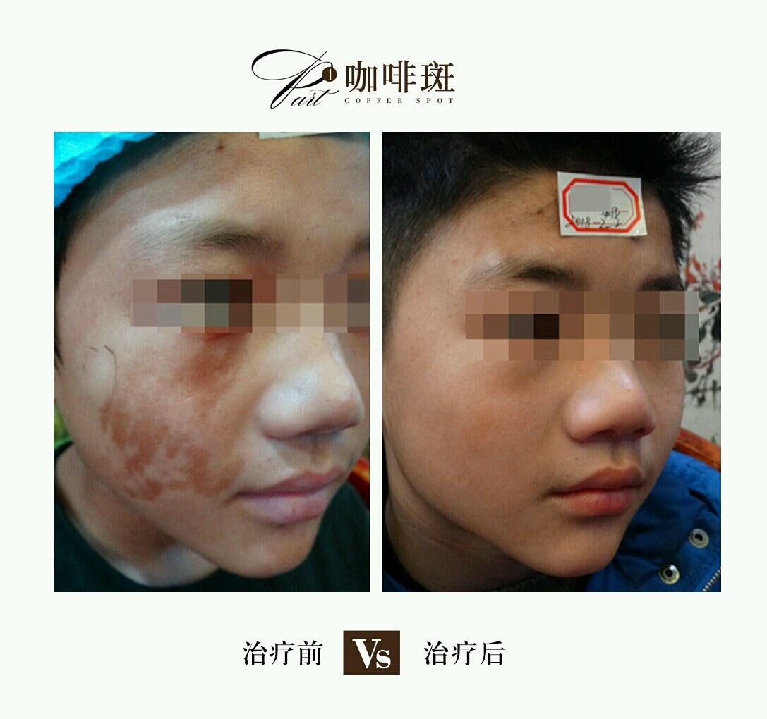 如何能有效的去除色斑