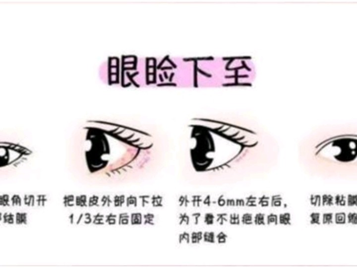 下眼下至术是指将下眼睑位置向下调整,露出部分眼白,让下眼睑的最低点