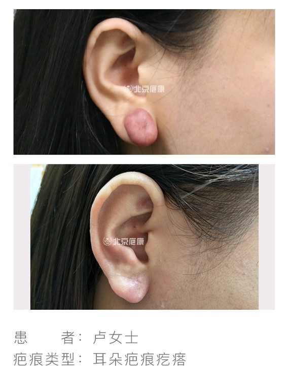 耳朵疤痕疙瘩在北京疤康综合防治下,做到了治愈不复发!