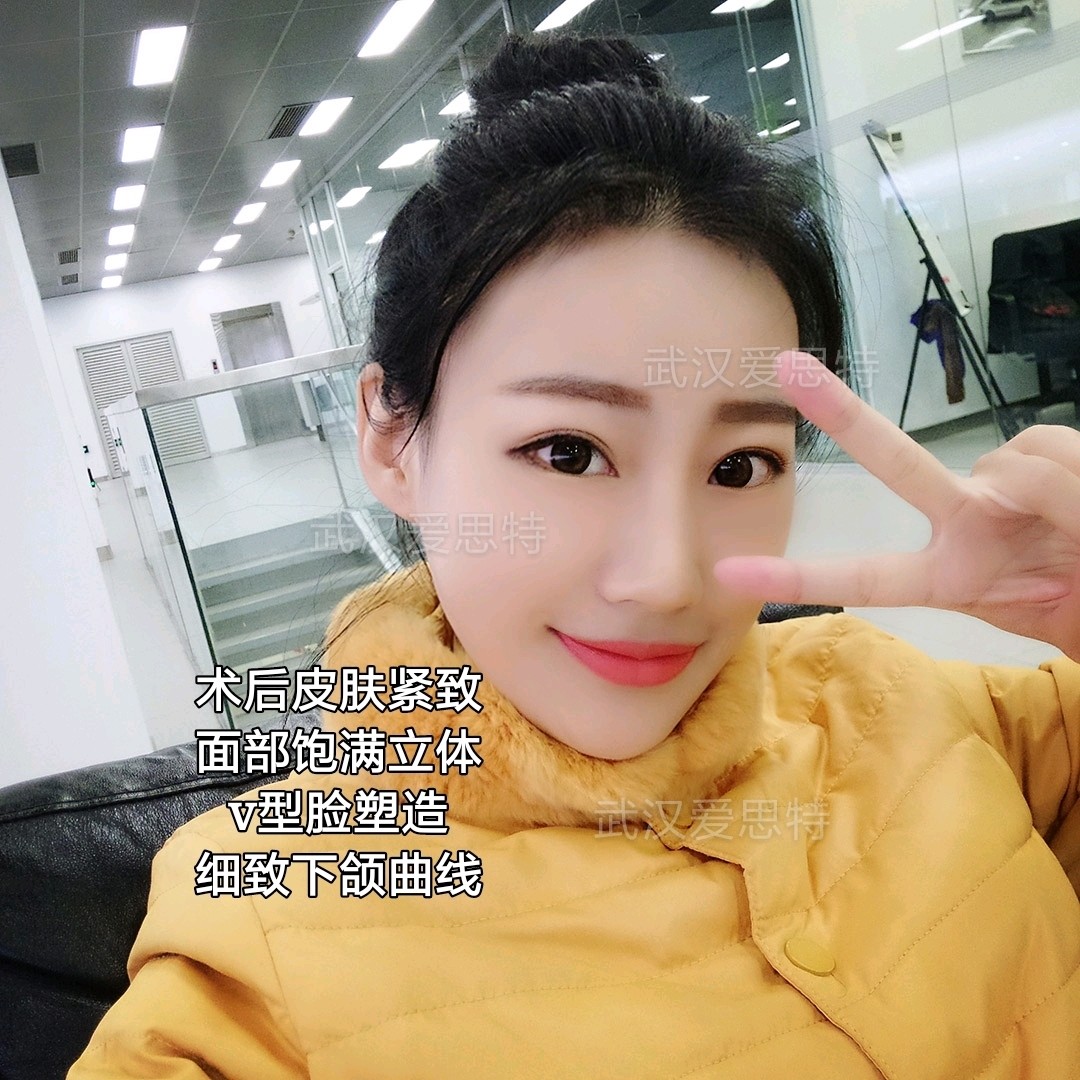 为什么有的人线雕后脸变形,线不吸收?