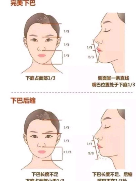 硅胶垫下巴