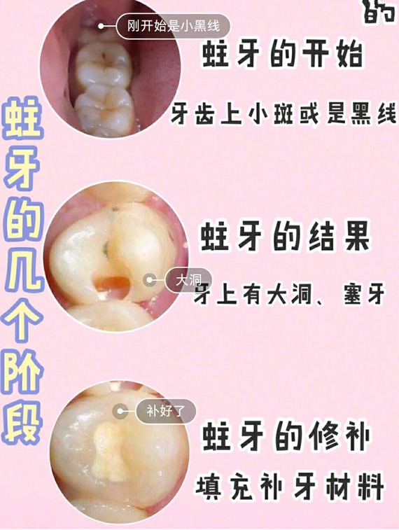 千万别忽视牙齿黑线!7878学会这几点没有蛀牙第