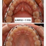 po主自己情况介绍:坐标:重庆矫正时年龄:20岁价格:8800元全包正畸用