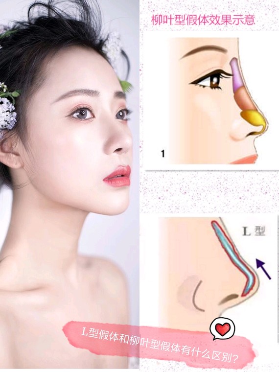 l型假体和柳叶型假体有什么区别
