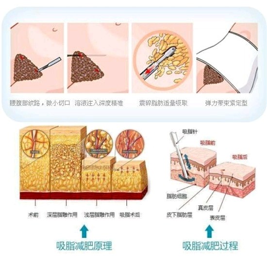 无套路科普贴告诉你腰腹吸脂手术哪些人不可以去做
