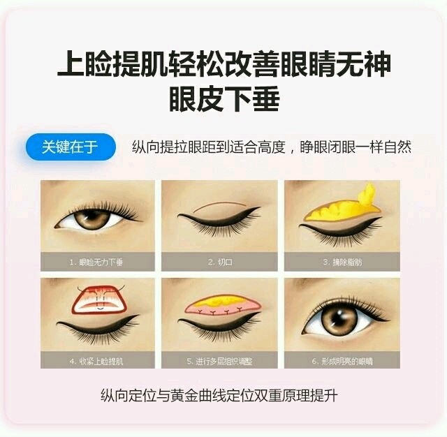 上睑眼提肌适合人群