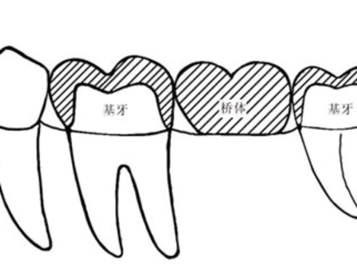 缺牙区做桥体,通过连接体连接成一整体,最后用粘固剂固定在基牙上