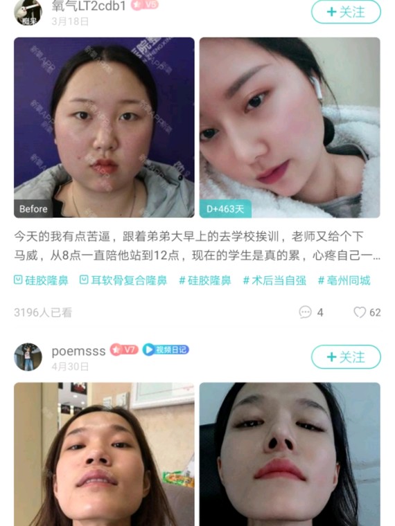 成都西区肖凌做坏鼻子!做坏了!医生不见你!咨询师还要骂你!