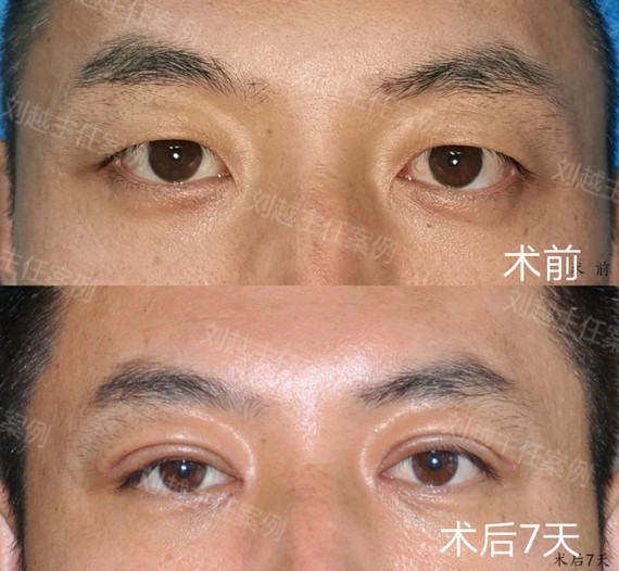 双眼皮