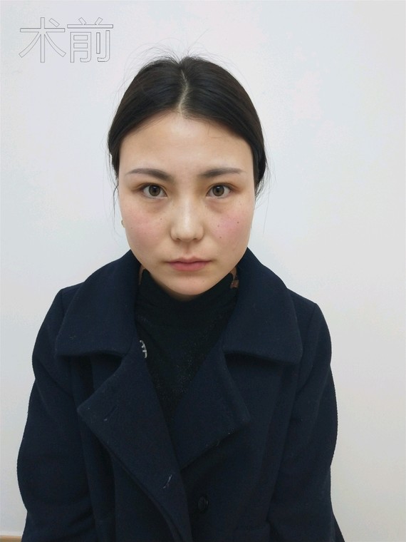 如何避免打肉毒素面部凹陷下垂