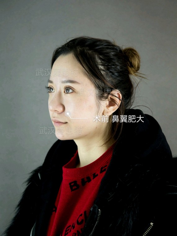鼻翼肥大,只做鼻翼缩小可以吗?