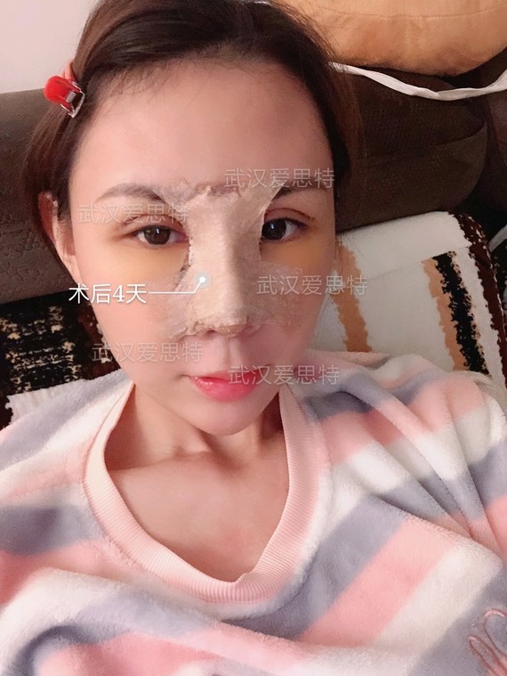 硅胶假体取出后皮
