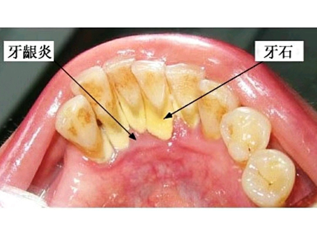 黑牙黄牙必看 还在纠结牙该不该洗