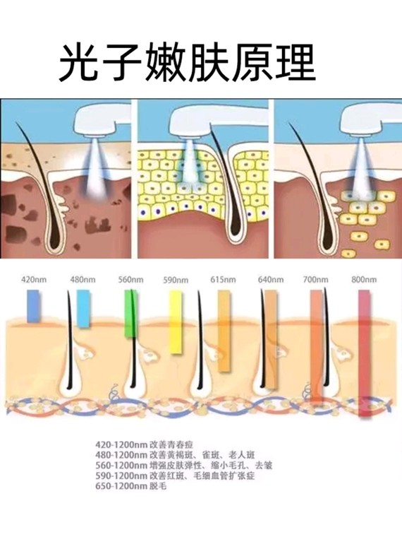 光子嫩肤真的有效吗