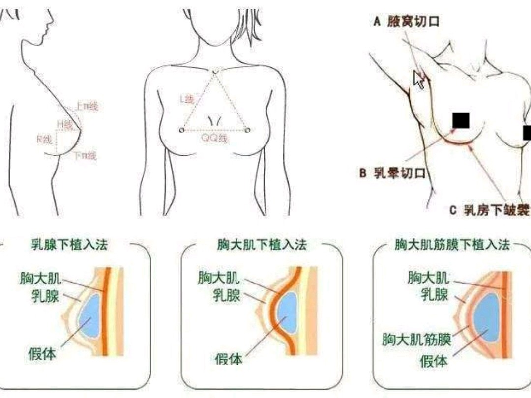 你可能只知道假体隆胸的切口有腋窝切口,乳晕切口,ru房下皱襞切口,但