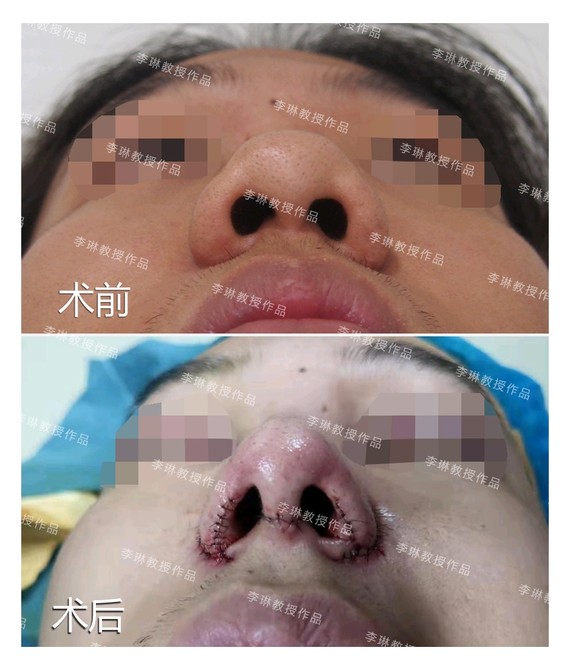 0505【今日份案例】0404男士鼻头鼻翼缩小.不