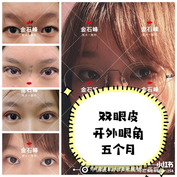 双眼皮开外眼角案例,1术前(存在设计画线
