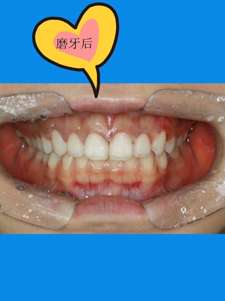 做贴面一定要磨牙吗磨牙做贴面=伤牙