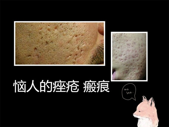 比如重度的痤疮,毛囊炎,血管炎等,都是会留下疤痕的.