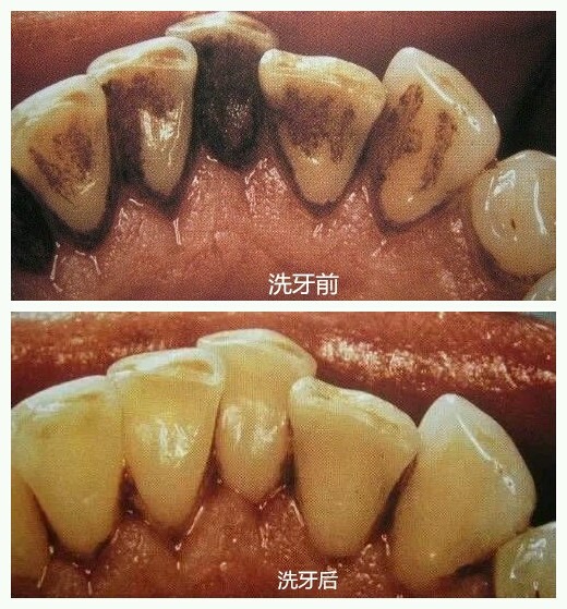 牙龈炎拖成牙周炎,最终的结果是牙齿团灭.