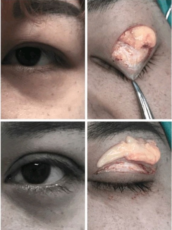 肿眼泡又叫肉泡眼,水泡眼.