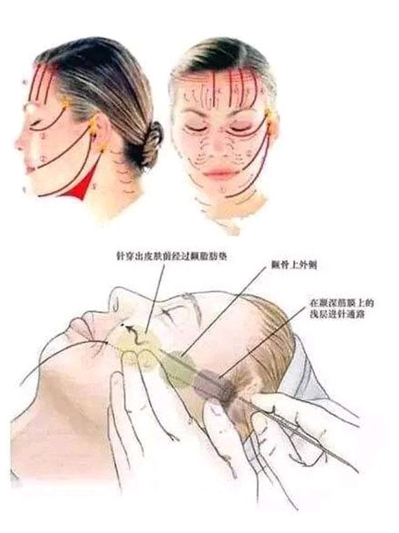 埋线后线会崩开?线雕术后这些注意事项要牢记