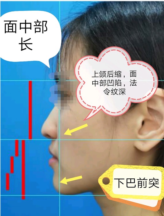 上颌后缩,下颌前突合并前牙代偿咬合尚可.表现为面中