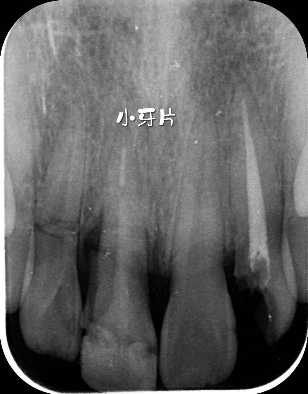 一张牙片可以显示3-4个牙齿,牙齿在牙片上显示出白色阻射影像.