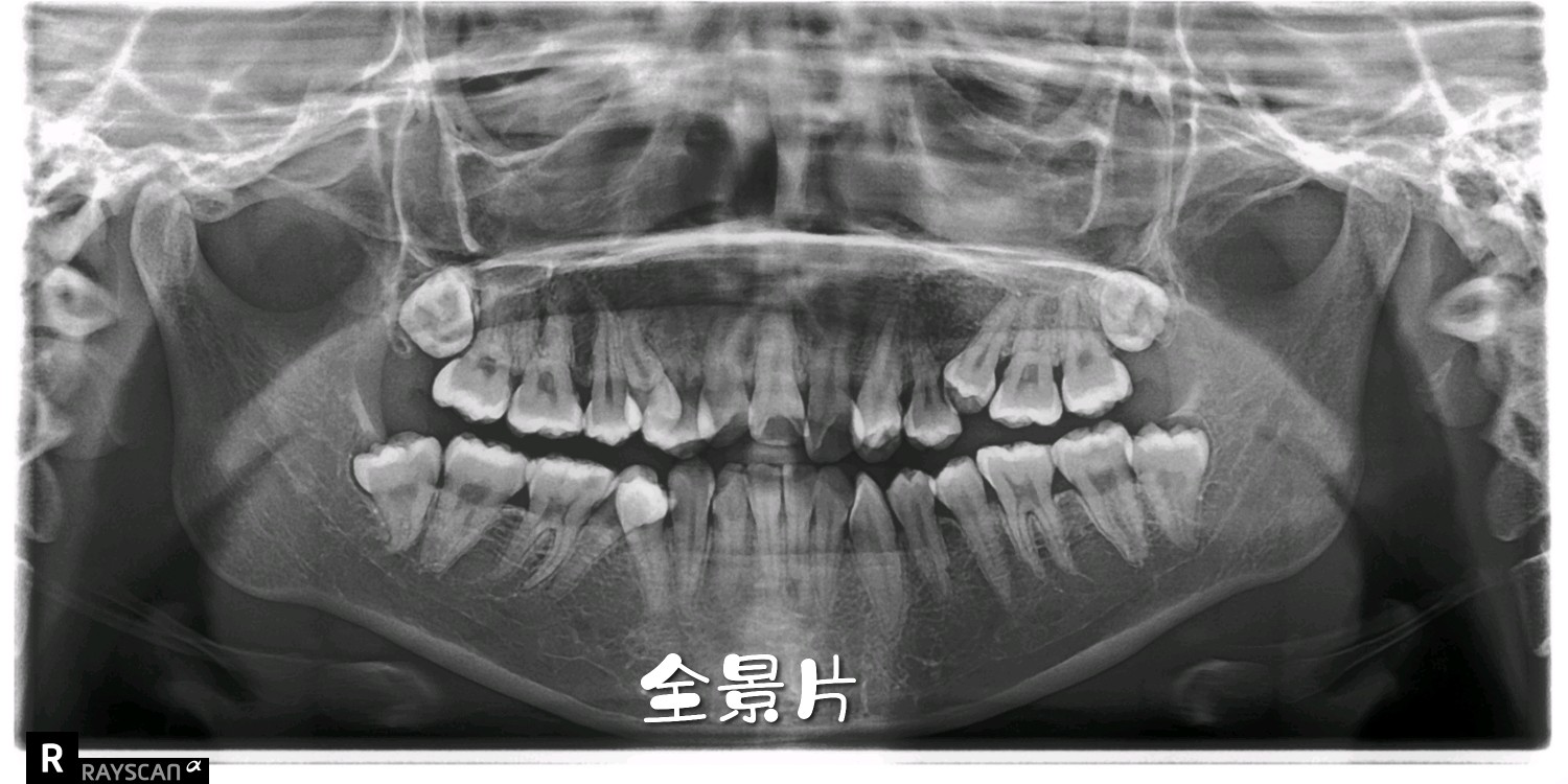 牙科常用的x光片主要有三种:小牙片,全景片和口腔cbct.