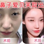 隆鼻后爱贝芙取出经历分享 以前我的鼻子是塌鼻梁,非常羡慕别人拥有高