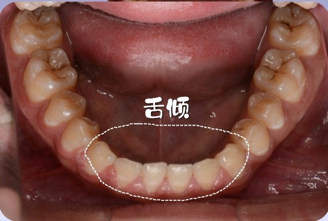 相反,如果牙齿向内向舌头方向倾斜了,就叫做牙齿舌倾, 磨牙外侧相邻