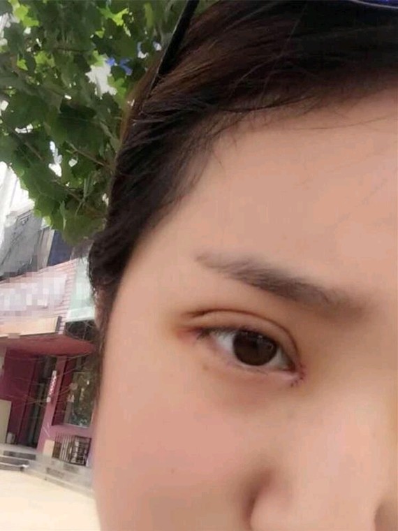 7015开眼角为什么容易出现疤痕增生?开眼角手术简