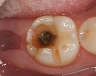 为什么有时牙齿表面只有一个小洞,却需要治疗牙神经?