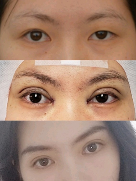 全切开扇双眼皮 去皮去脂 提肌 开内眼角女生术前的