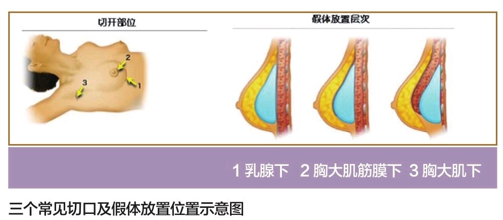 30岁左右的女生想做假体隆胸来改善胸部,却担心会变成假胸?