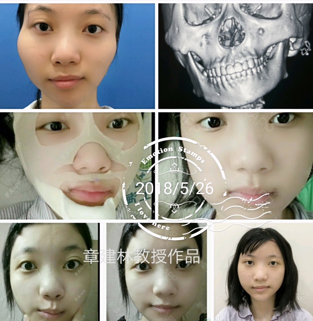 先天性半面短小症主要表现偏颌和耳朵缺.对于小孩我们