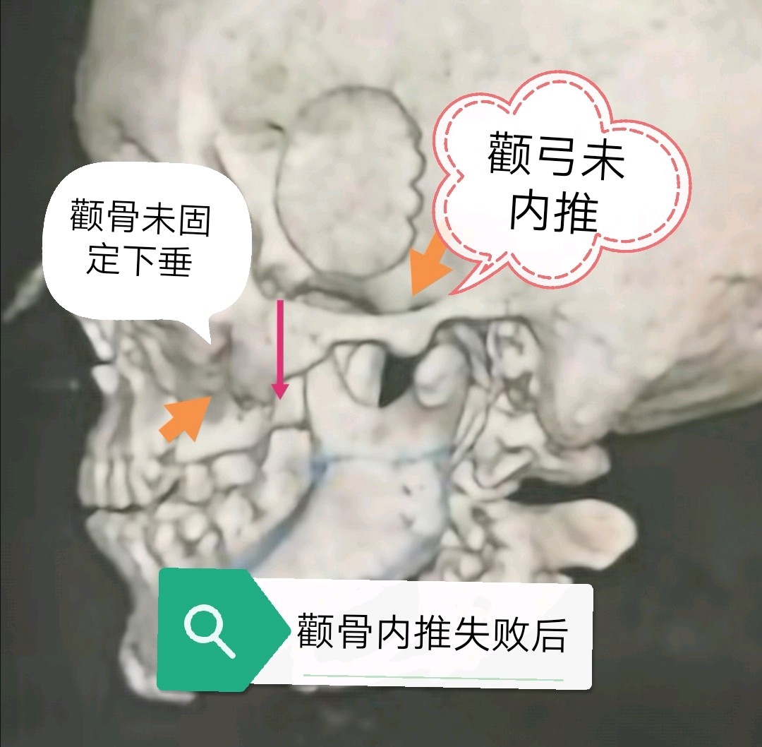 截骨内推后钛板钛钉坚强内固定是必不可少的.如果不固