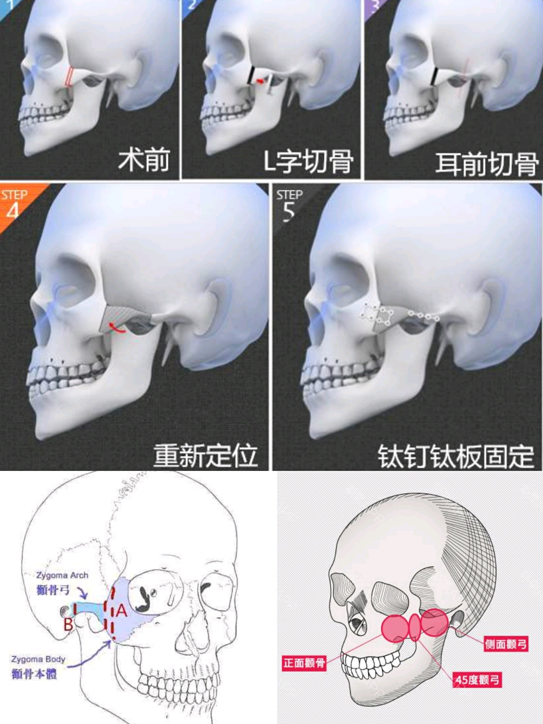 潘南奎返韩变河豚 填充似塞肉丸 疑颧骨内推后遗症