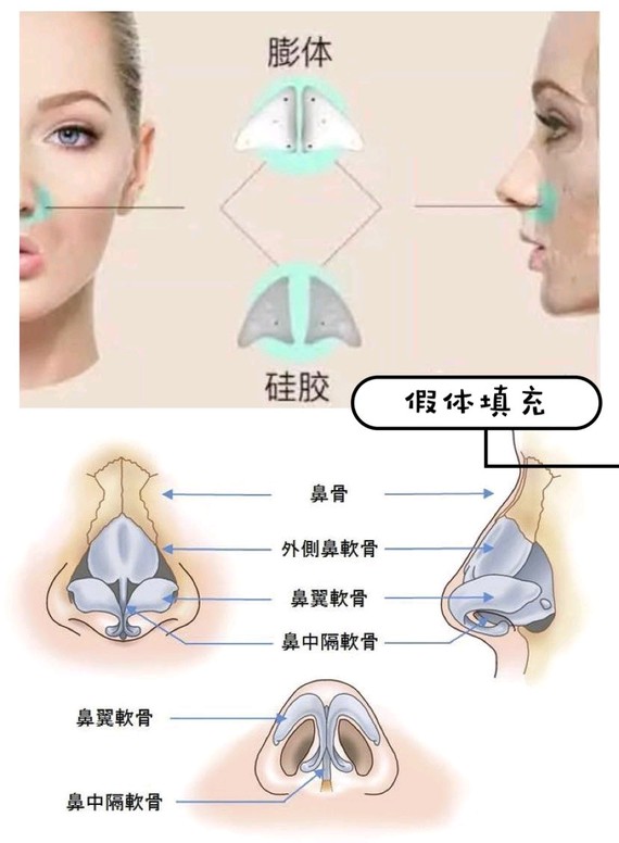 ♀鼻基底填充四大材料♀